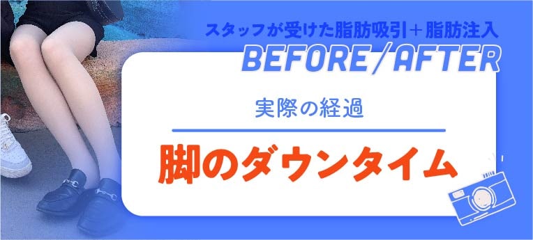 脚の脂肪吸引の経過