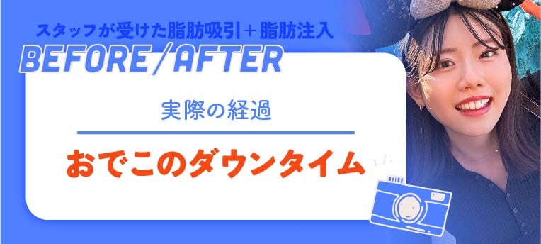 おでこの脂肪注入の経過