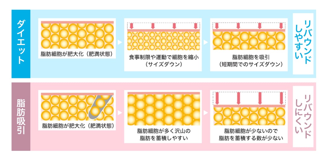 脂肪吸引とはどのような施術？