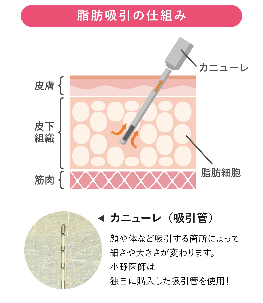 脂肪吸引の効果とメリット