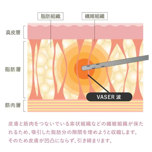 ベイザー脂肪吸引で引き締め効果を最大化