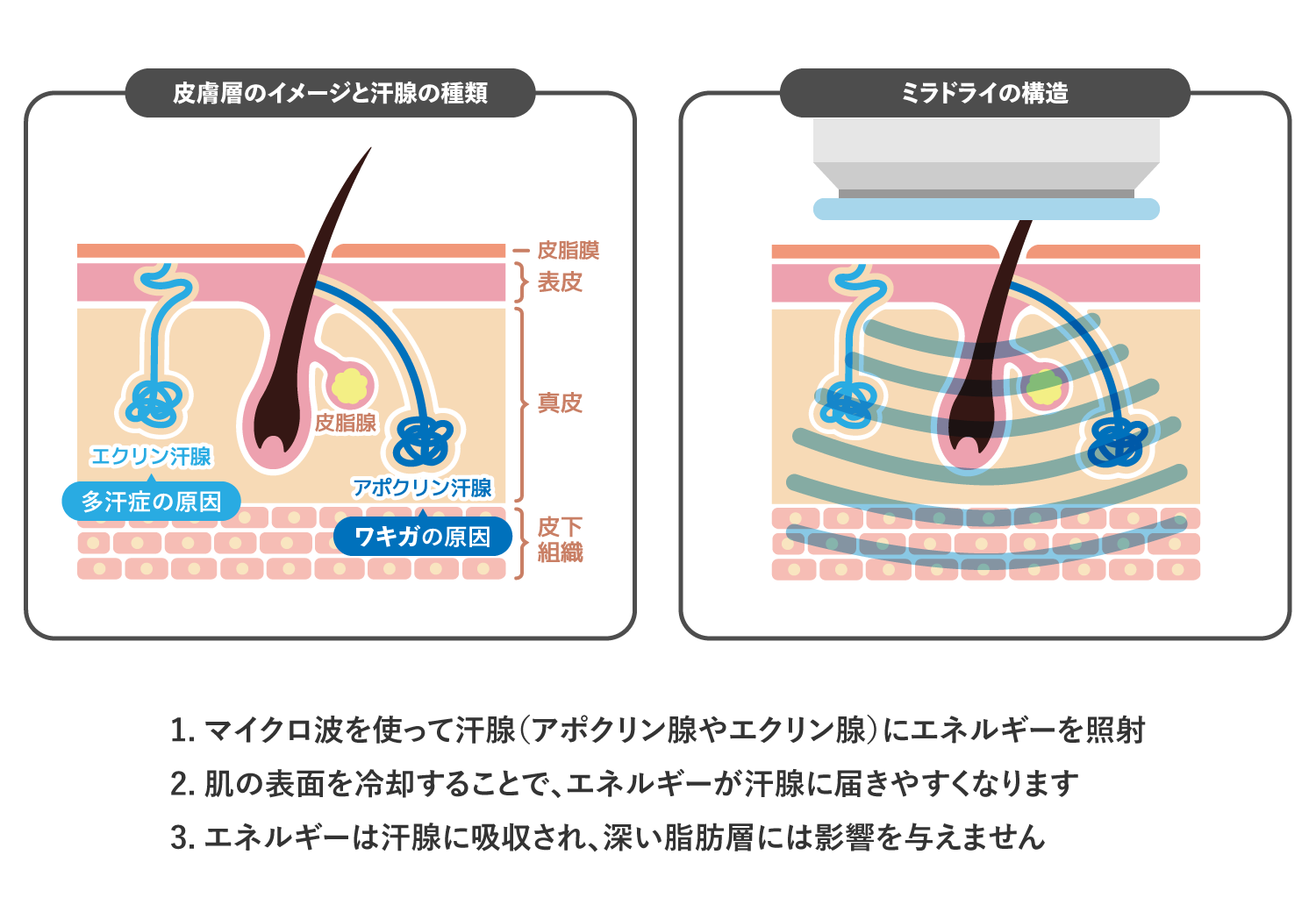 ミラドライの特徴