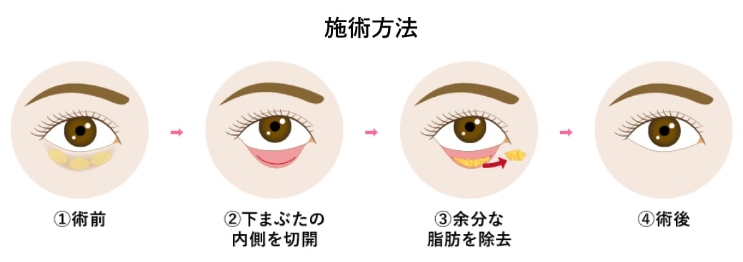 「目袋3脂肪」を除去する治療