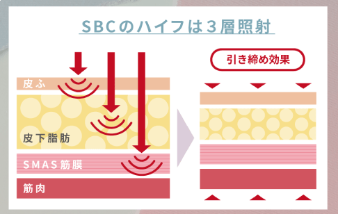 医療ハイフの効果