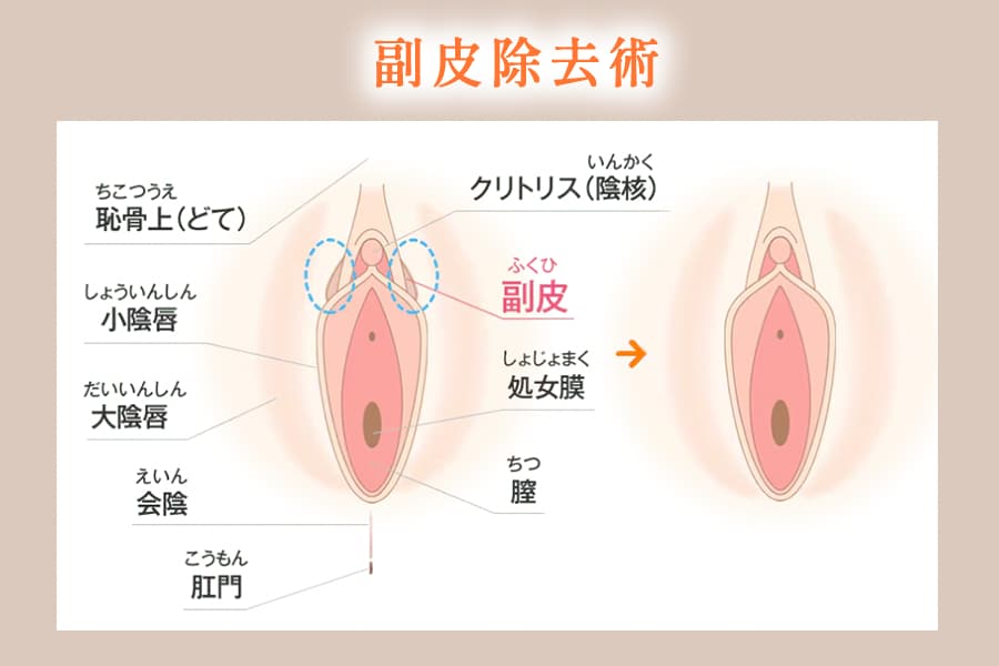 副皮除去術