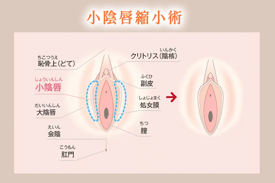 小陰唇縮小術