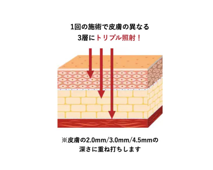 業界内最大ショット数とトリプル照射