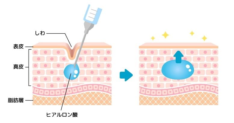 ヒアルロン酸　ジュビダームの特長