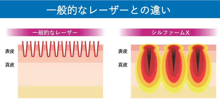 おすすめ理由②　肌の奥までレーザーが届く
