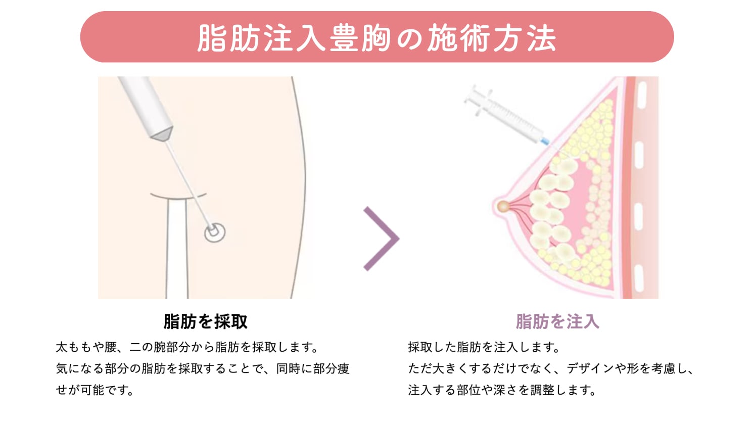 脂肪注入豊胸とは自身の脂肪を胸に注入し、バストアップする施術です。