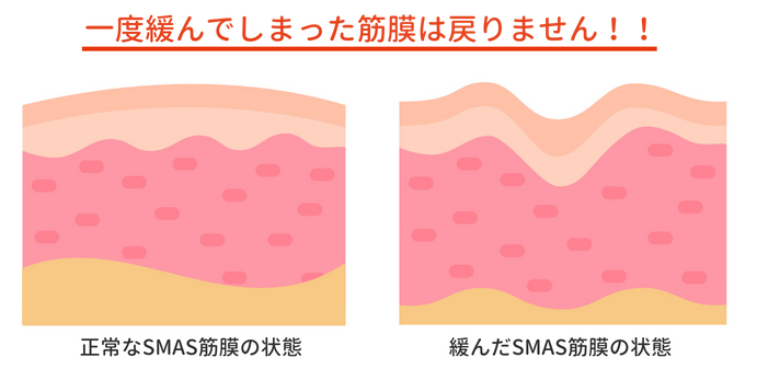 たるみの原因【SMAS筋膜】