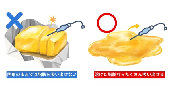 ベイザー併用アキーセル脂肪吸引がオススメ！その理由とは？