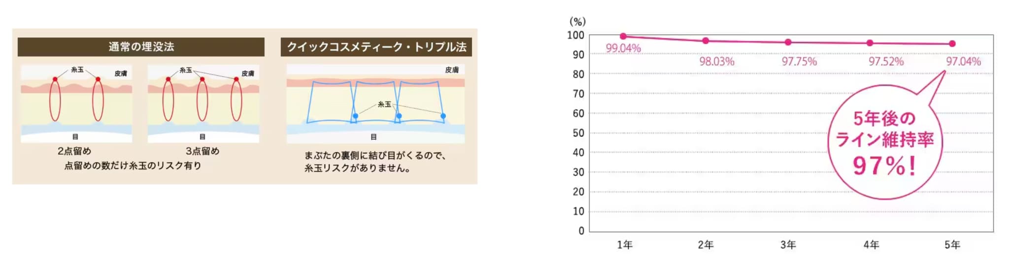 なぜ埋没でも大丈夫なの？？