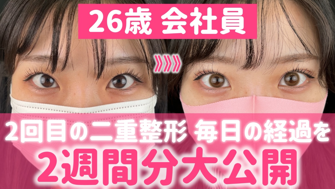 名古屋で埋没するなら高川がすごい！？二重整形2週間のダウンタイムを大公開！さらに今の様子まで…！