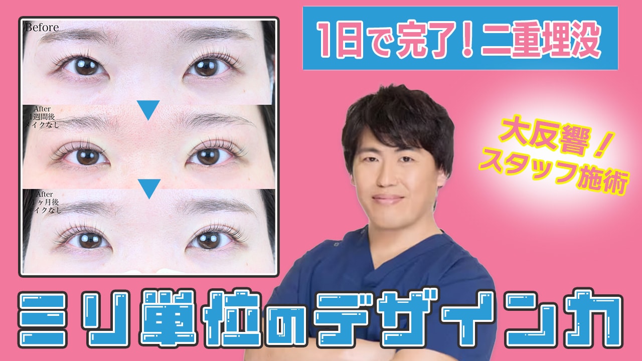 【二重整形密着】デザインと仕上がりの良さが魅力！山本先生で2回目の埋没♪