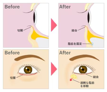 切開ハムラ法とは？