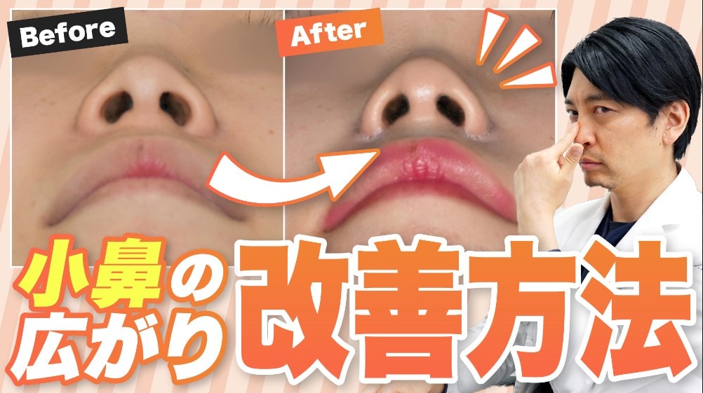 【美鼻の名医★】名古屋栄院の中野達生医師が小鼻の広がりの改善方法を解説します！