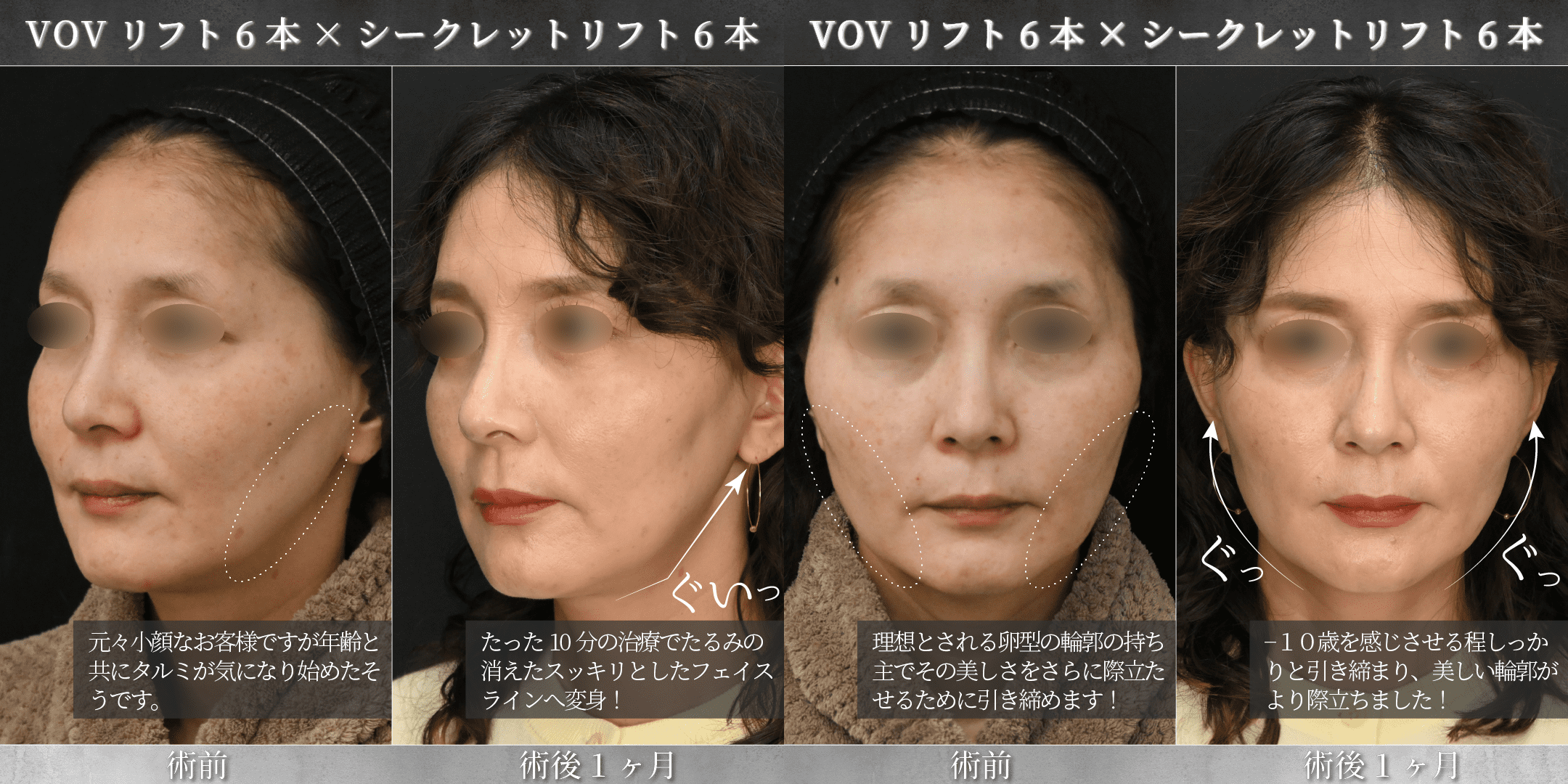 美しいフェイスラインを求める人必見