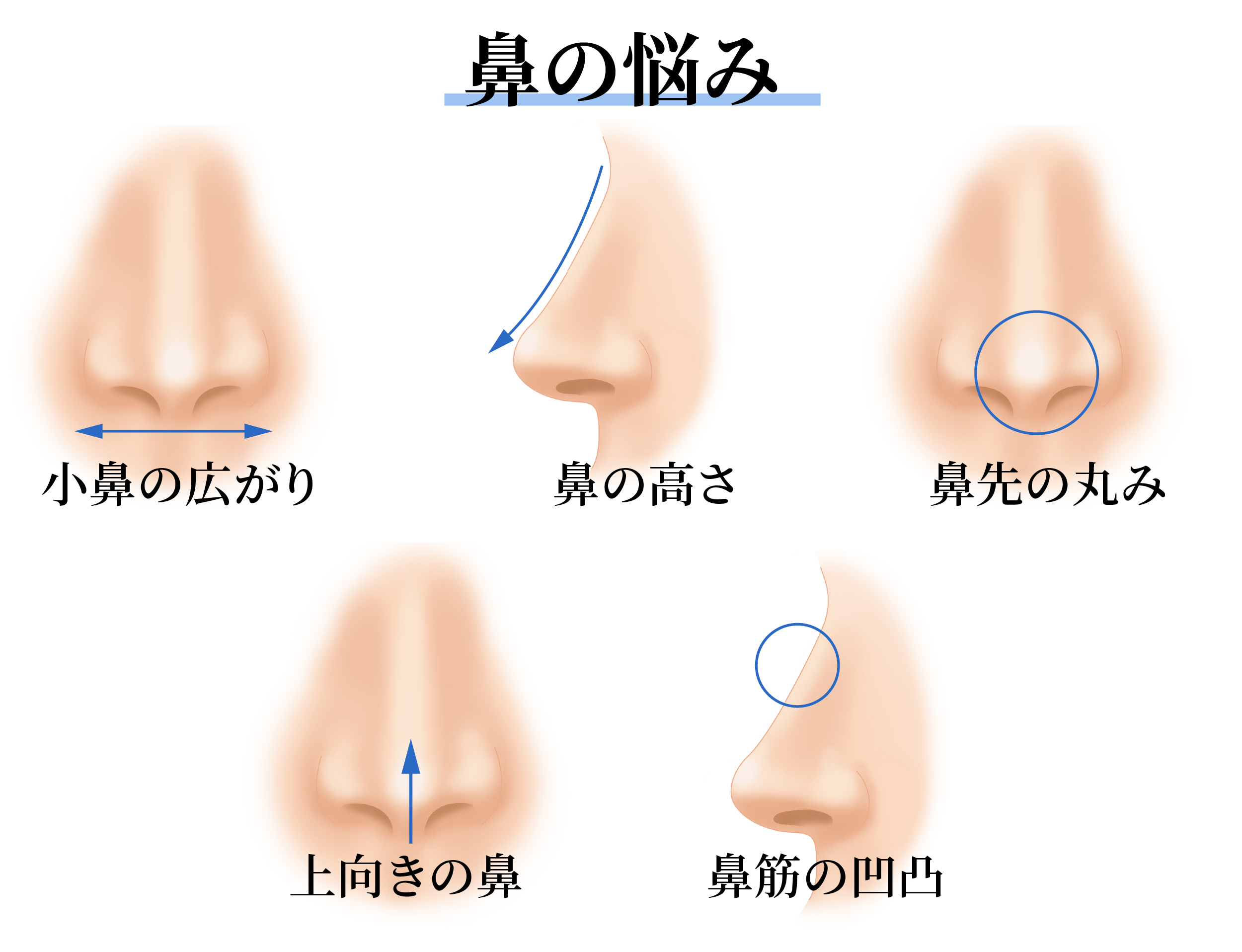 ここ治したい！とよく相談される鼻のお悩みランキング