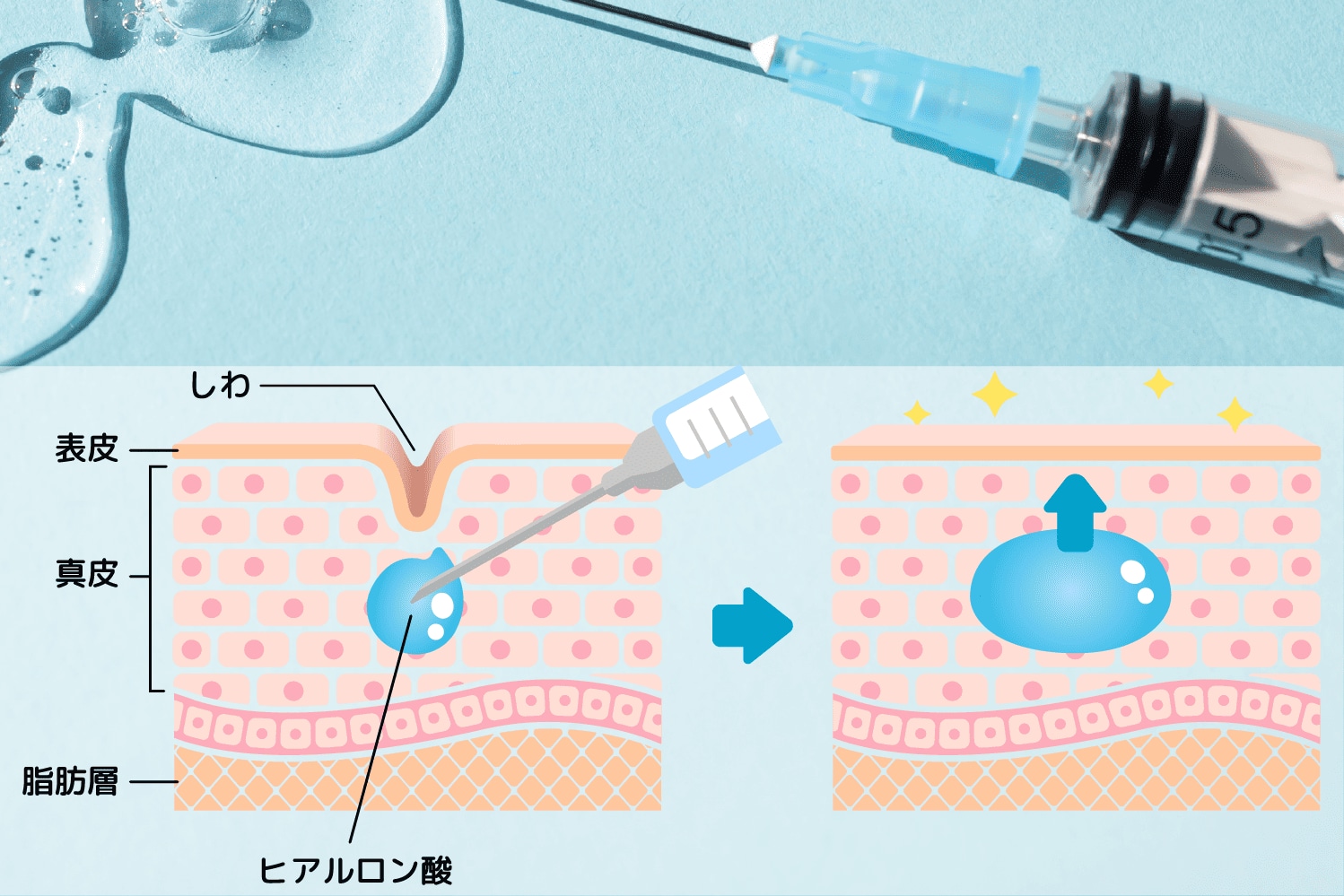 体内にある物質を注入して改善するヒアルロン酸