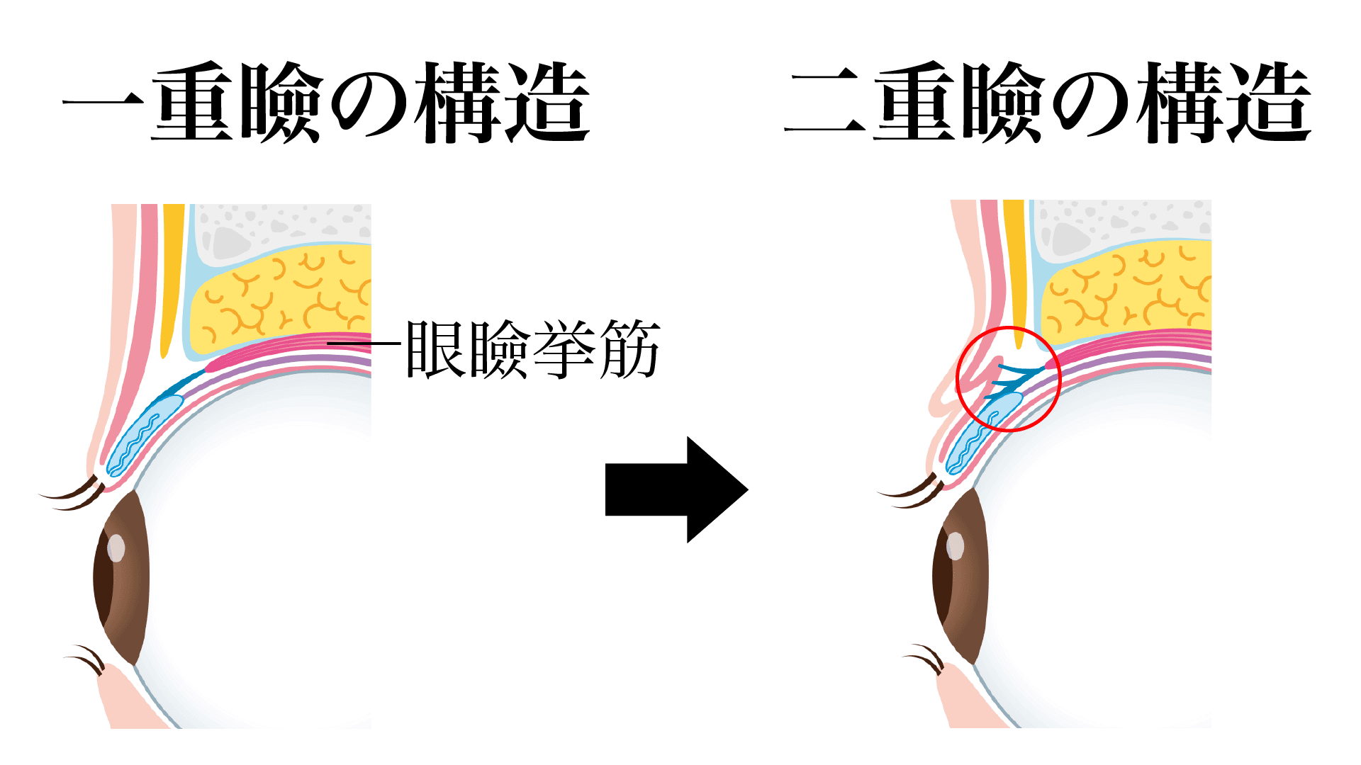 一重瞼と二重瞼の構造