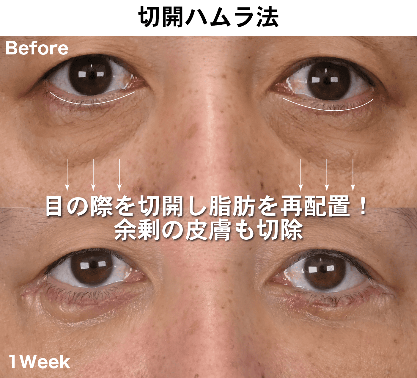 切開ハムラ法（表ハムラ法）