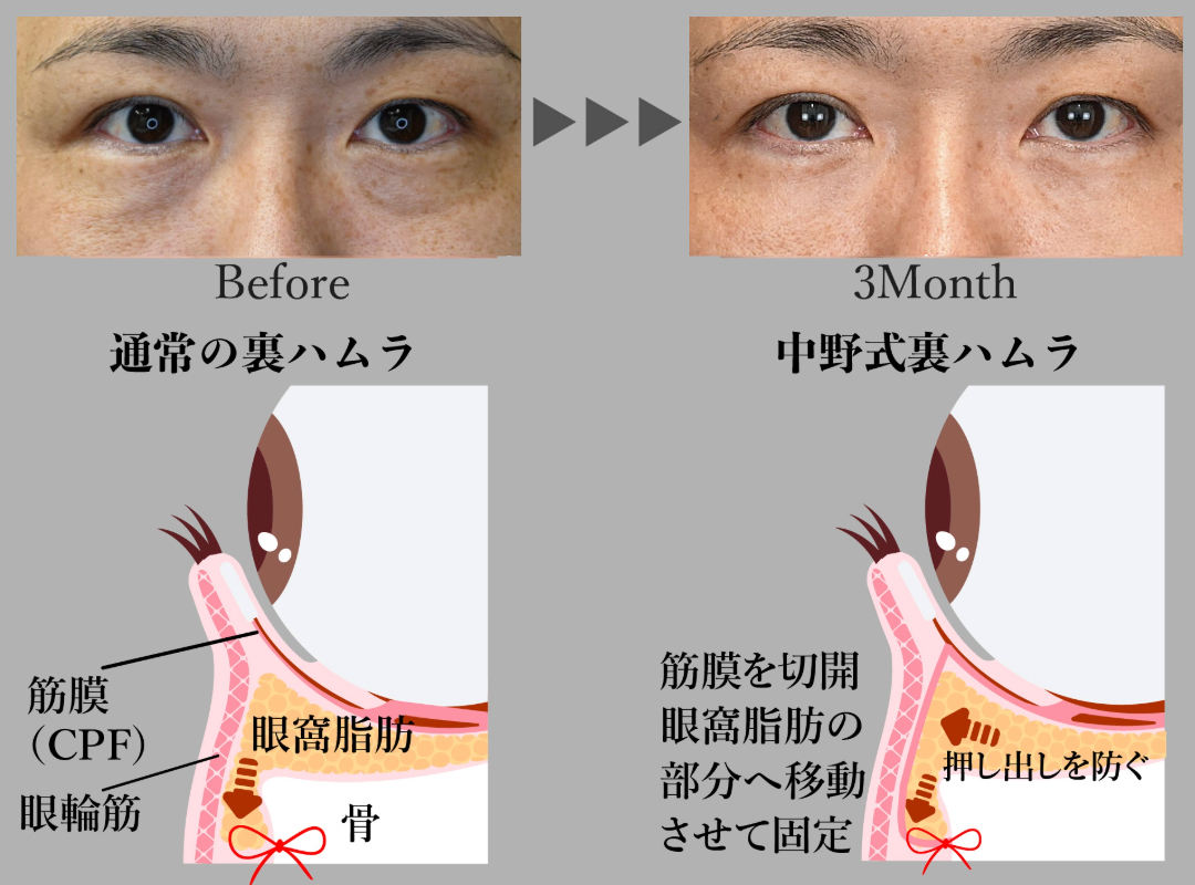 筋膜で眼窩脂肪を固定し再発を防ぐ