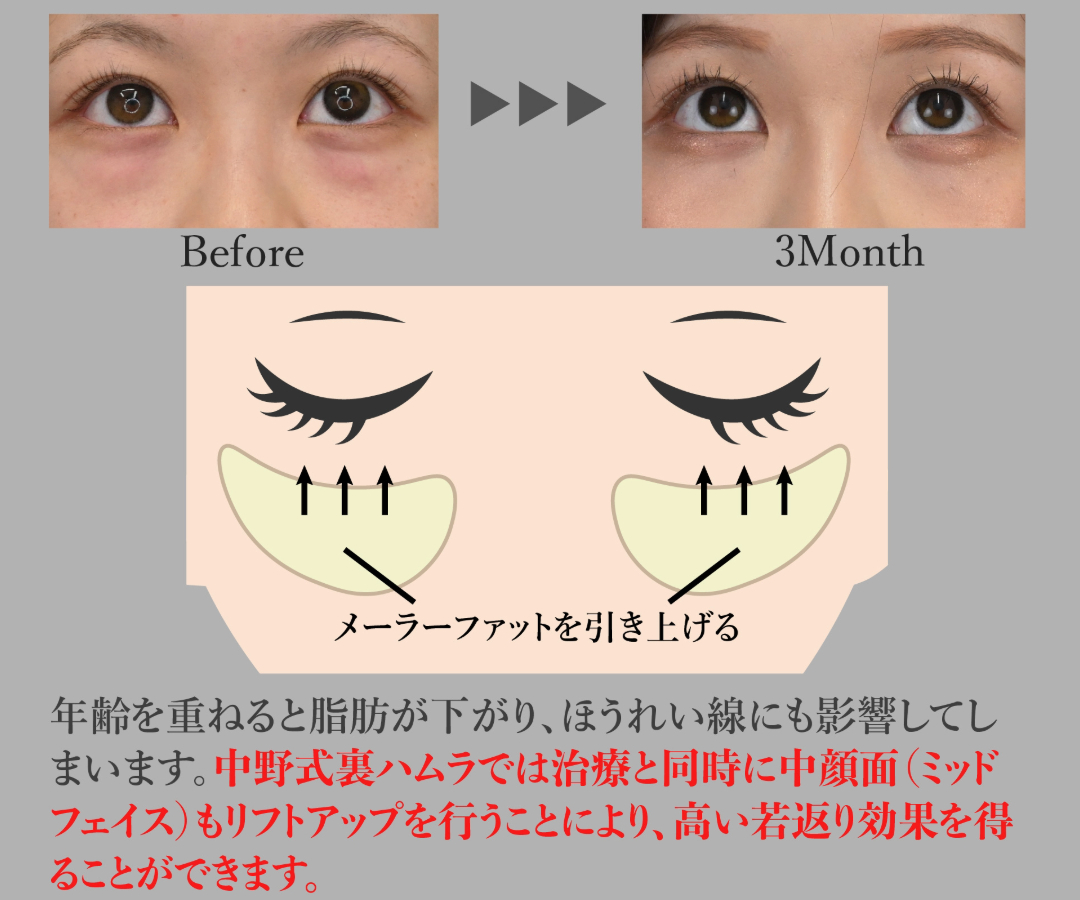 同時に中顔面を引き上げより高い若返り効果を与えます