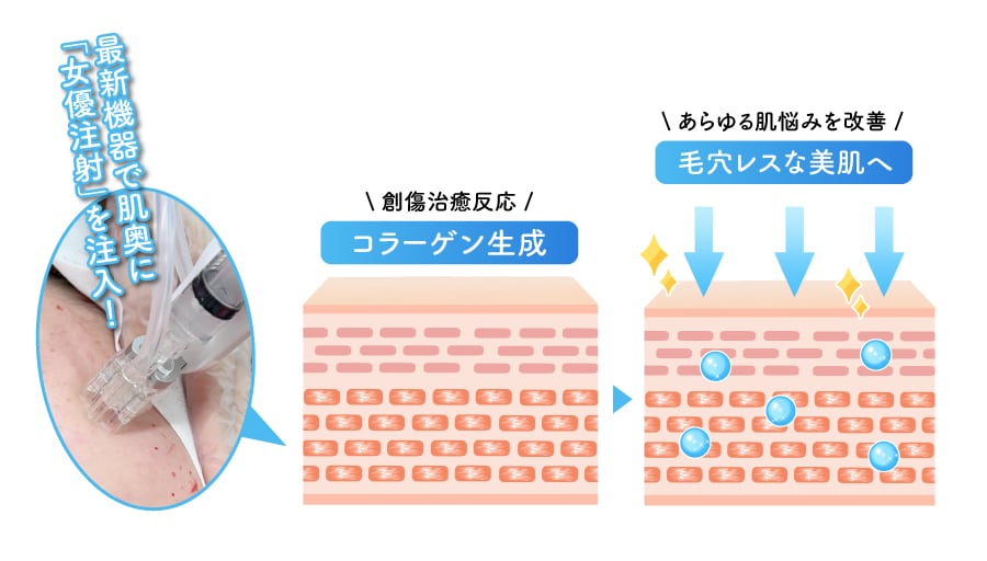 毛穴レスを目指す肌育施術