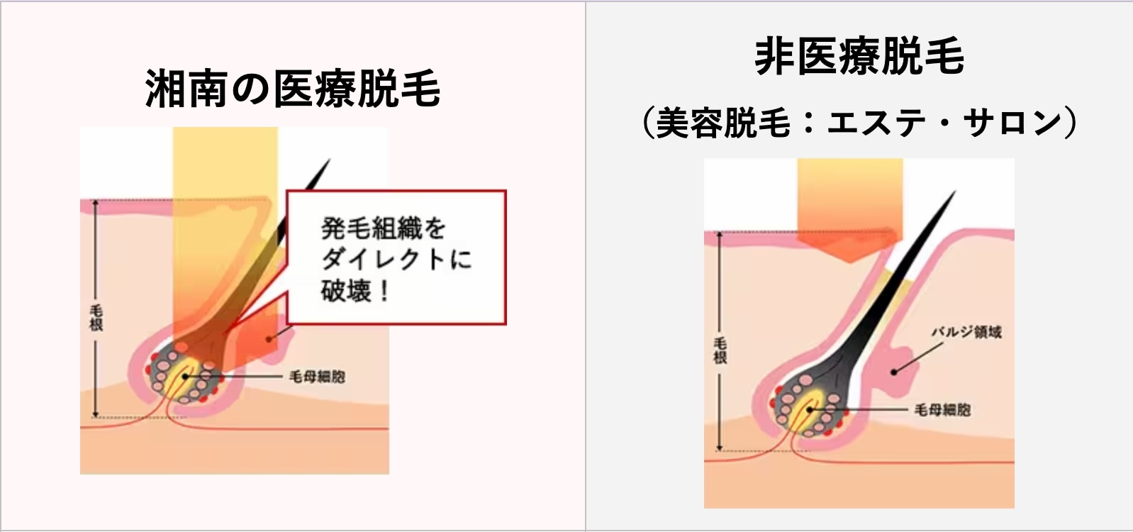 非美容脱毛と美容脱毛（エステ・サロン）の違い