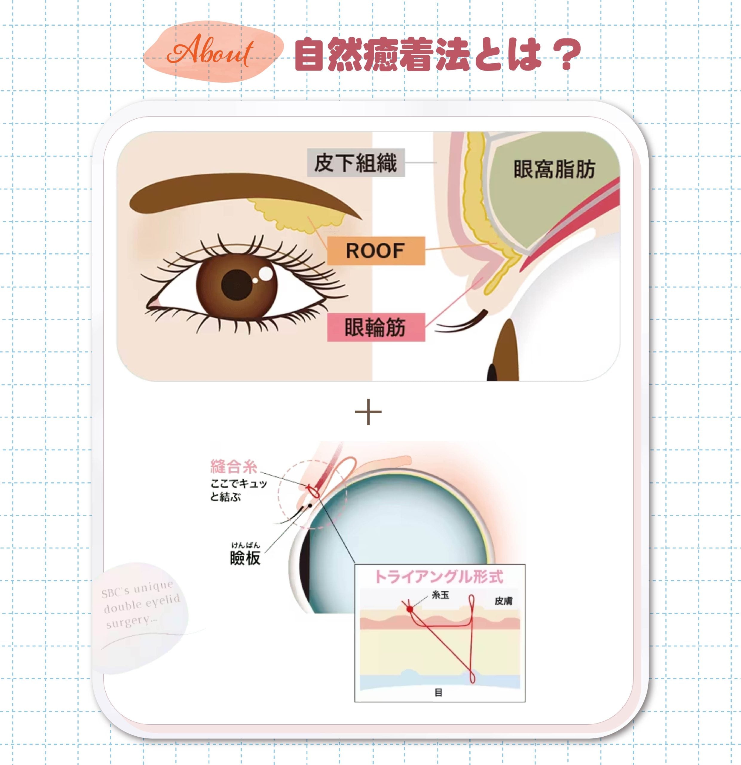 極細の医療用糸で二重を作ってまぶたを数ミリ切開。ぱっちり目を作る！