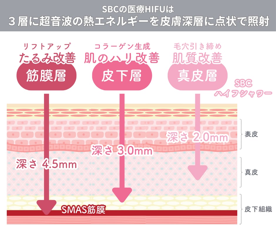 ３層に超音波の熱エネルギーを照射