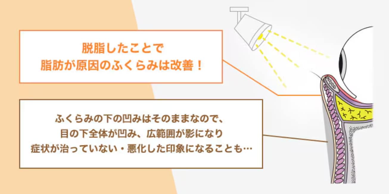 なるべく安く受けたいので脂肪注入はしたくないです。<br />
しない場合はどうなりますか？