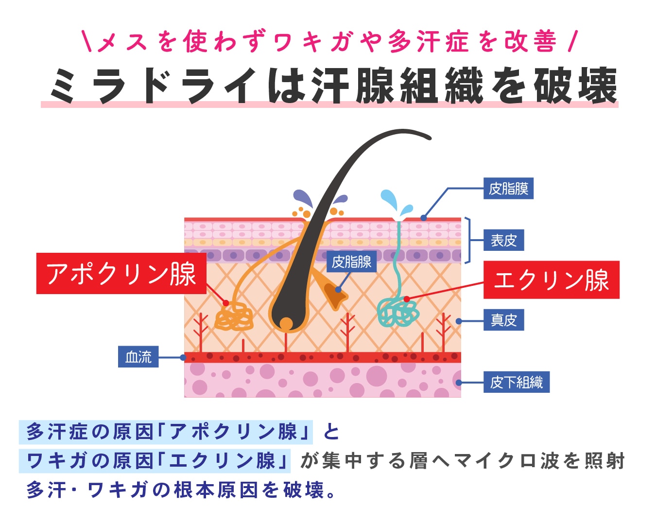 メスを使わずワキガや多汗症を改善！