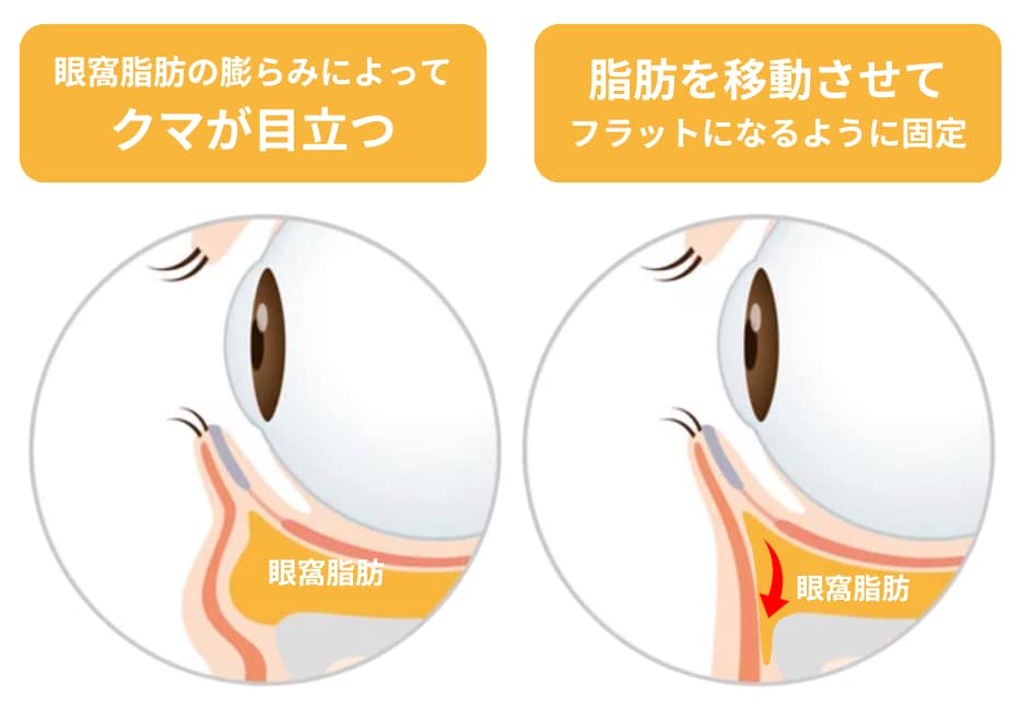 膨らみと凹みを同時に改善する施術