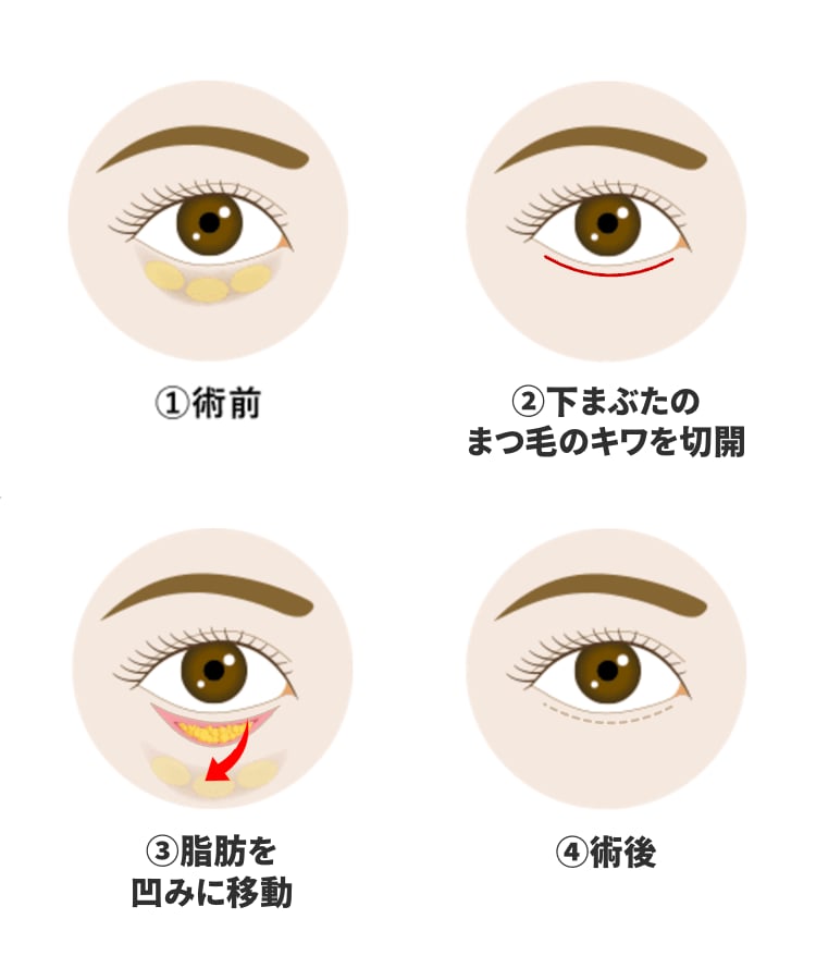 切開ハムラ法