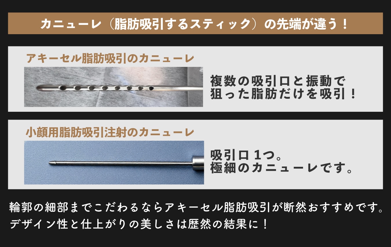 アキーセル脂肪吸引 vs. 小顔用脂肪吸引注射の違い