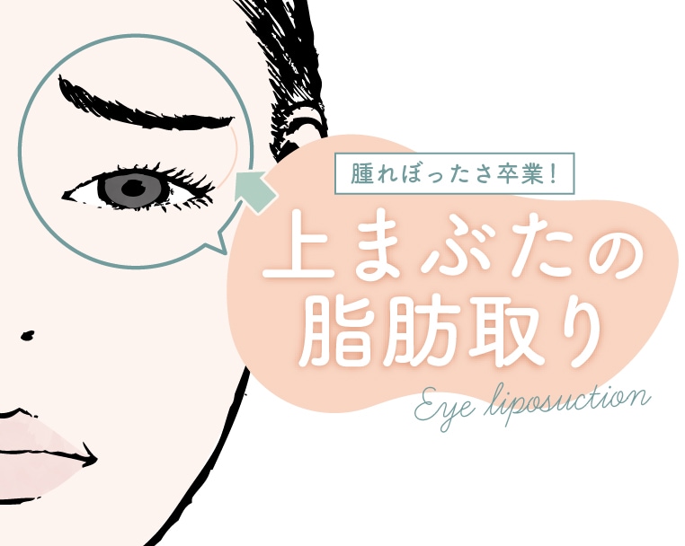 【岡山で上まぶたの脂肪取りならSBC岡山院】傷口やダウンタイム、デメリットまで解説