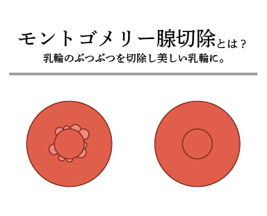 モントゴメリー腺切除