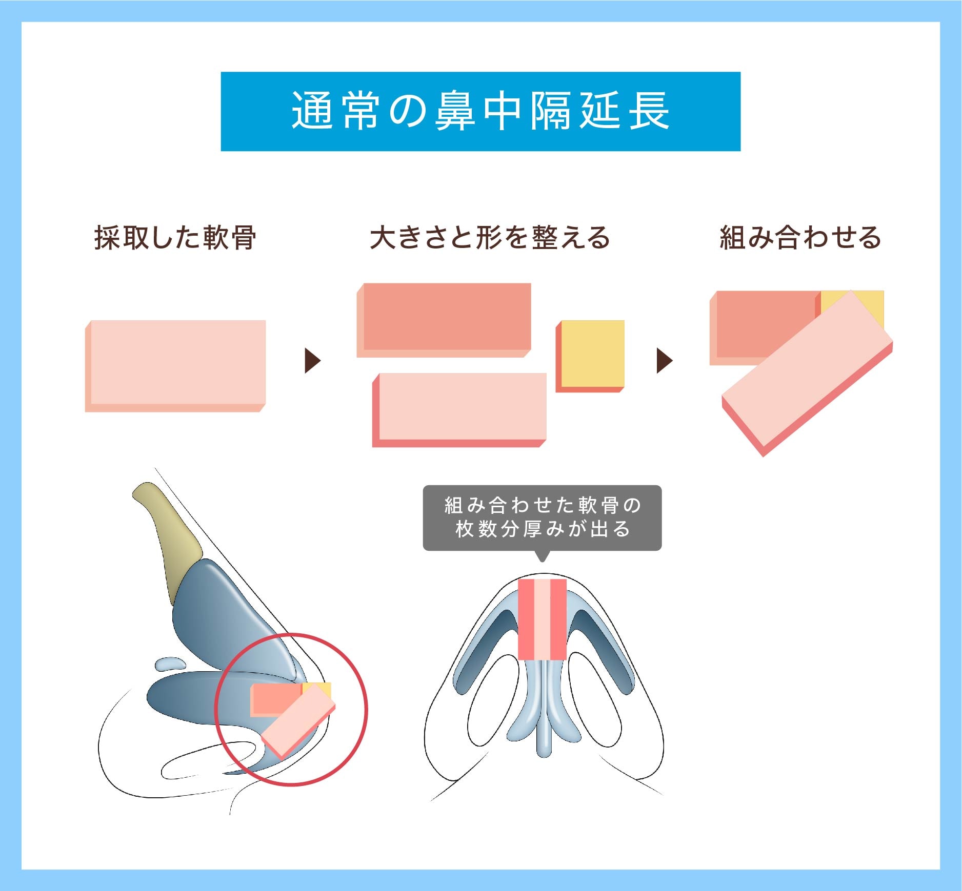 仕上がりの良さと後戻り防止を両立させた「Xグラフト法」