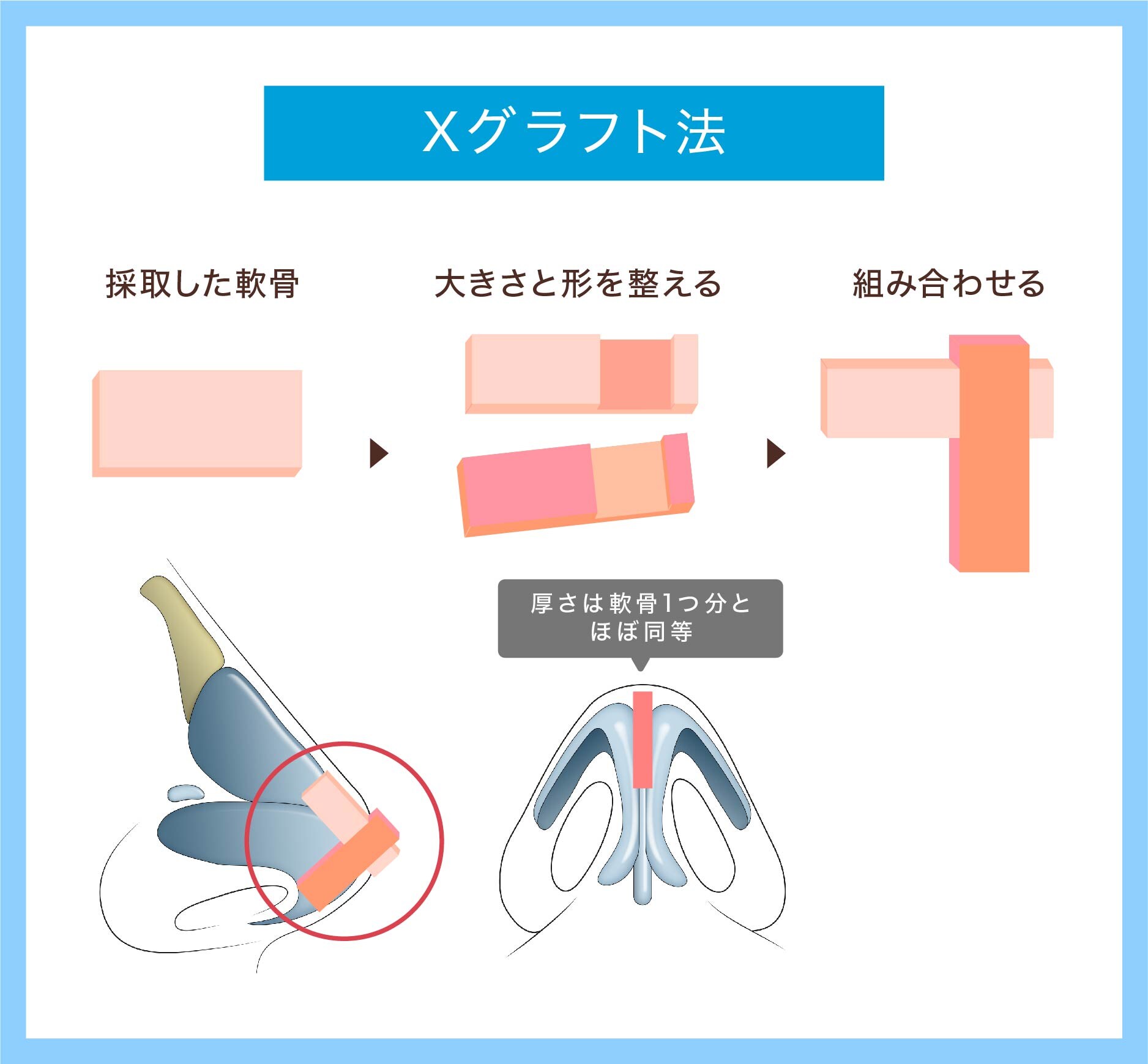 Xグラフト法とは？