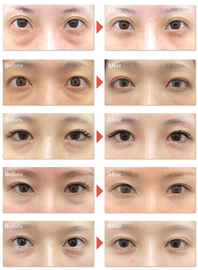 目の下の切らないクマ・たるみ取り＋脂肪注入<br />
(術前→術後1ヶ月後の様子)