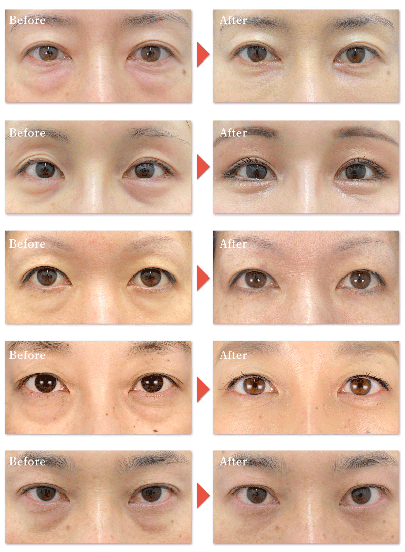 目の下の切らないクマ・たるみ取り＋脂肪注入<br />
(術前→術後1ヶ月後の様子)