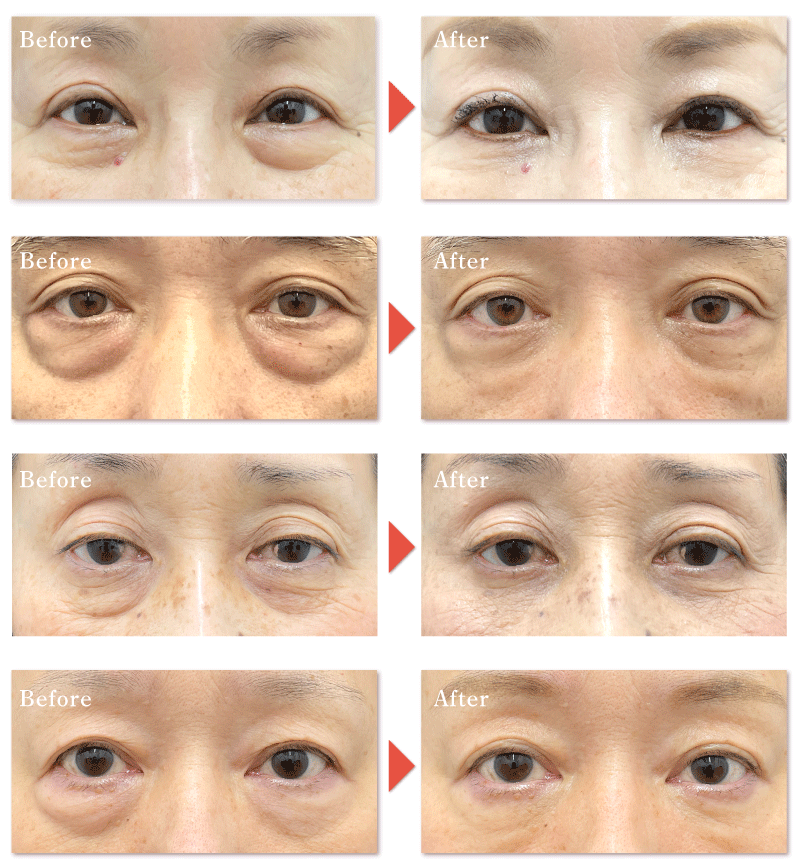 目の下の切らないクマ・たるみ取り＋脂肪注入<br />
(術前→術後1ヶ月後の様子)