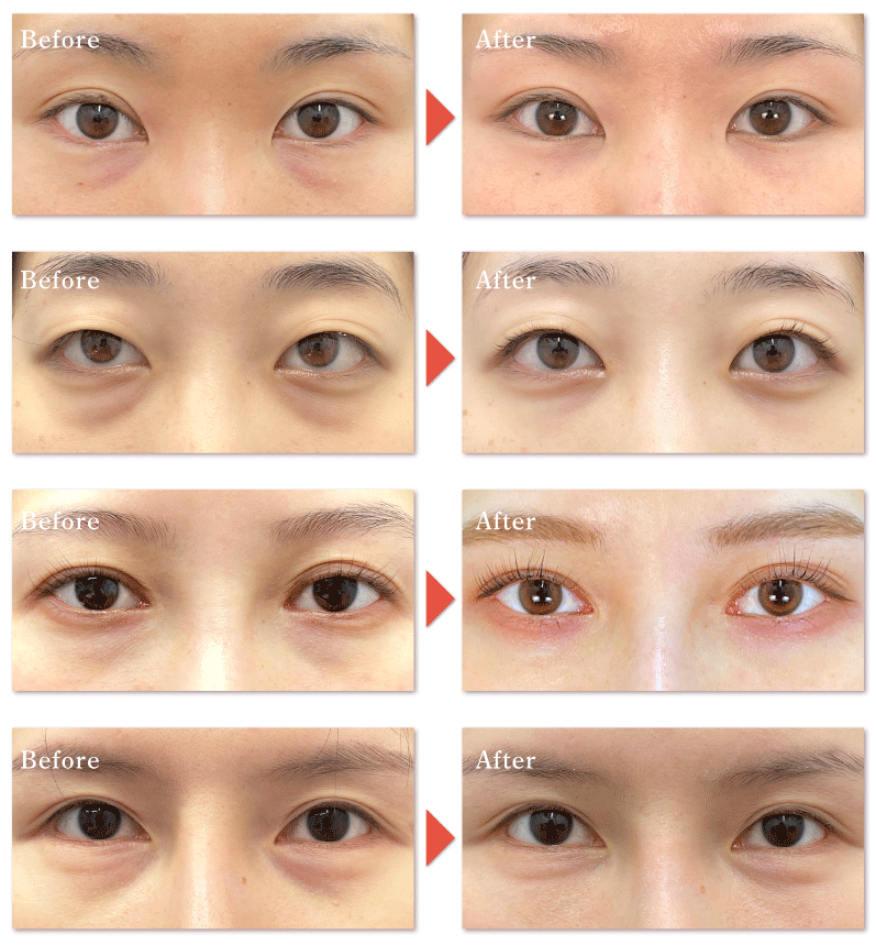 目の下の切らないクマ・たるみ取り＋脂肪注入<br />
(術前→術後1ヶ月後の様子)