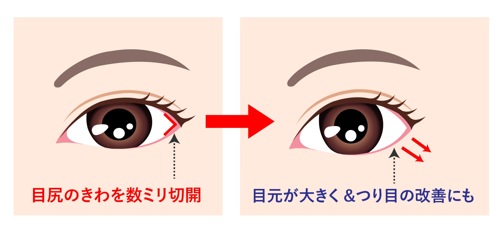 つり目改善や、目元を大きくする効果