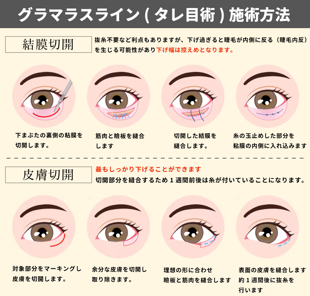 ③「控えめ〜限界まで」希望に合わせて術式を変更して理想に近づける