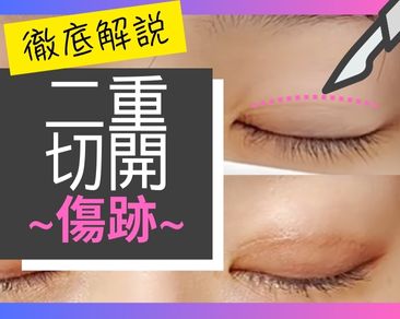 二重切開の傷跡ついて徹底解説！二重切開を検討するにあたって気になる”傷跡”についてのご不安を解消します。