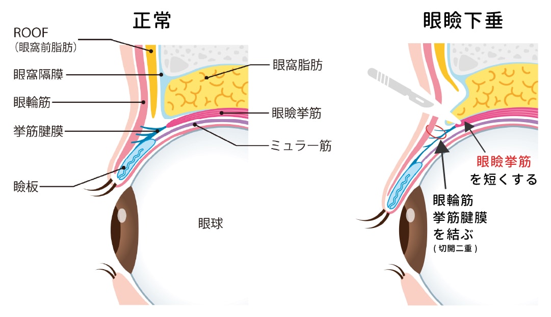 実は、ほとんど切開法と工程が一緒。