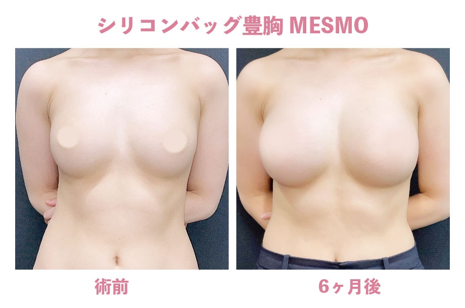 《シリコンバッグ豊胸》MESMO(両側220cc)の症例